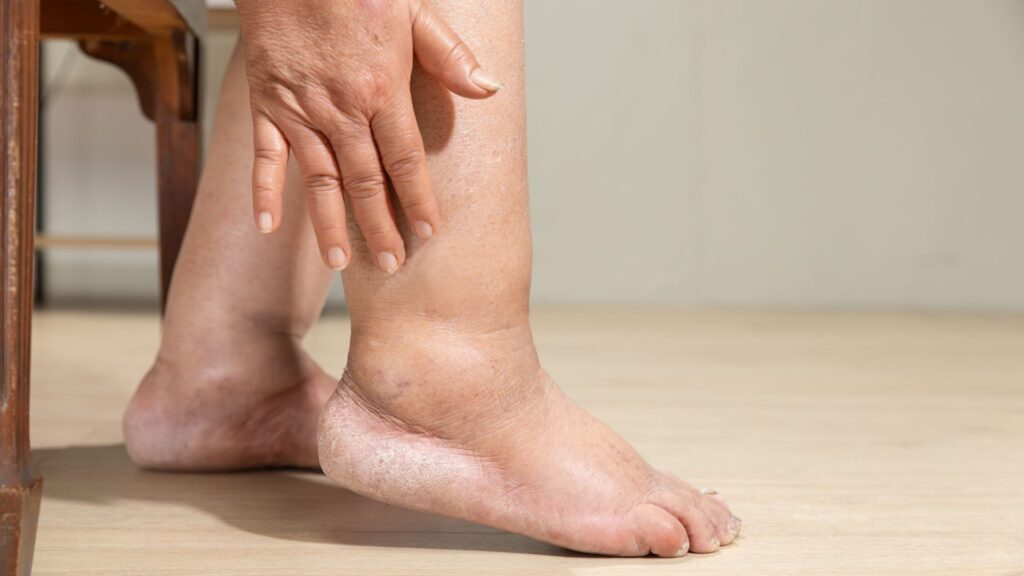 足のむくみがある女性の写真|長浜市の循環器内科こだまクリニック